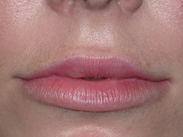 LipsAfter2