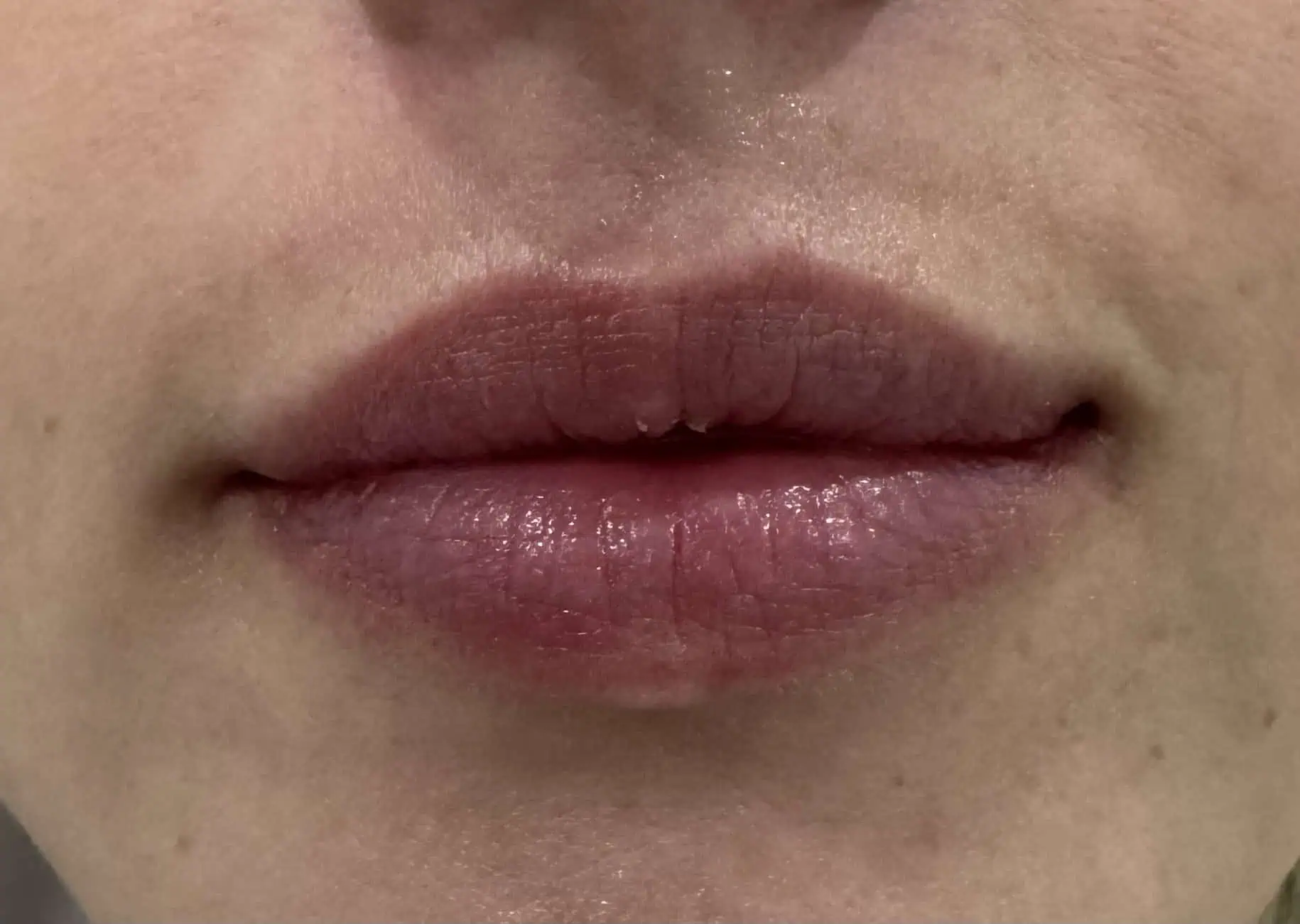 Lip-filler-after