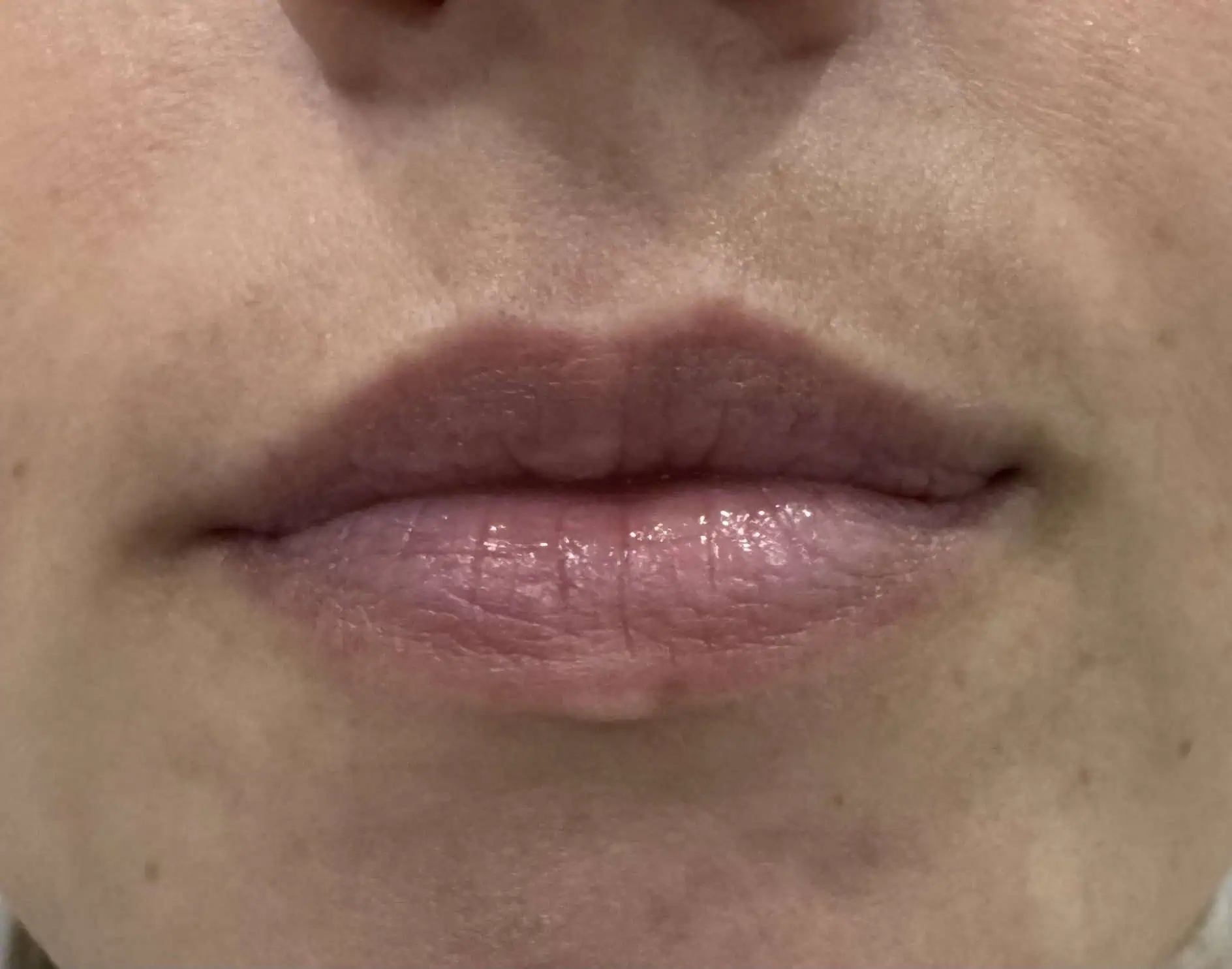 Lip-filler-before