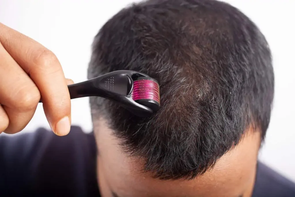 Scalp Microneedling in Hoboken, NJ and Weehawken, NJ | 1aesthetics