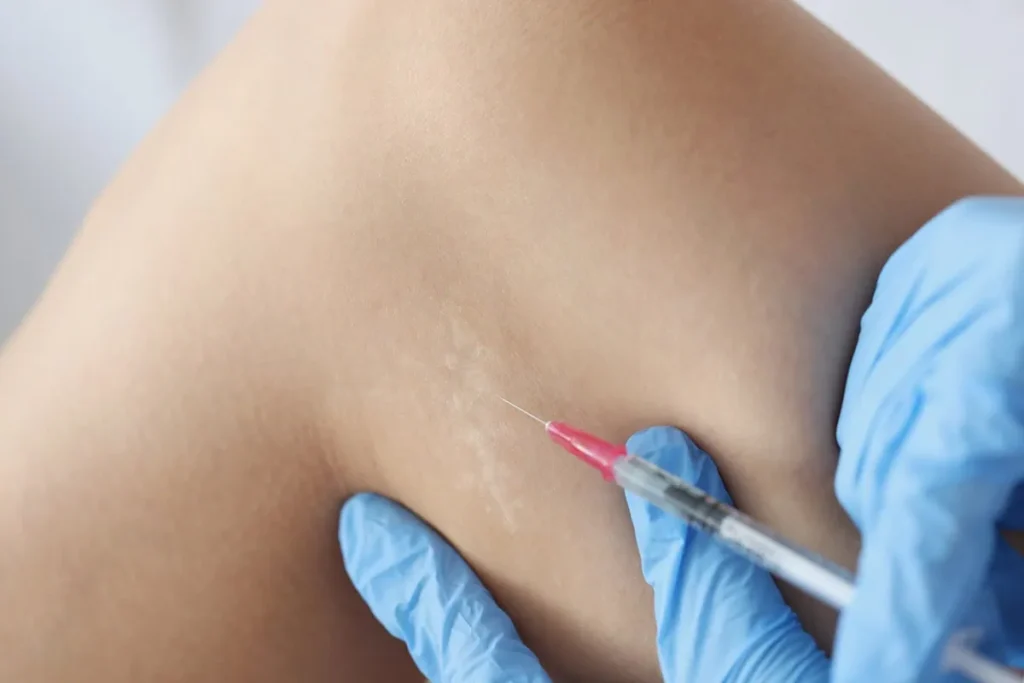 Steroid injection in Hoboken, NJ and Weehawken, NJ | 1aesthetics