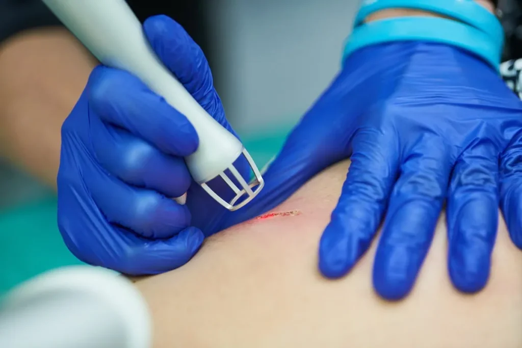 Laser Scar Removal in Hoboken, NJ and Weehawken, NJ | 1aesthetics