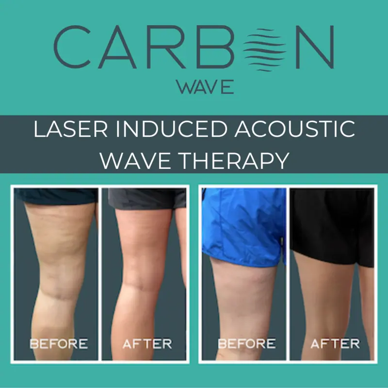 carbon wave treatment before and after in Hoboken, NJ and Weehawken, NJ | 1aesthetics