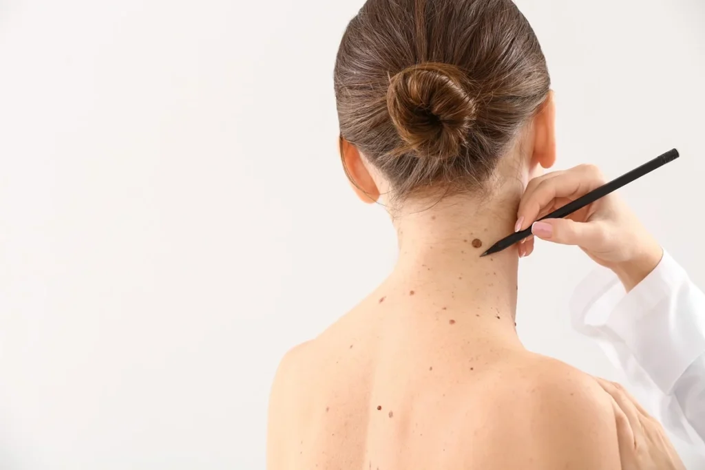 Mple and skin tag removal in Hoboken, NJ and Weehawken, NJ | 1aesthetics