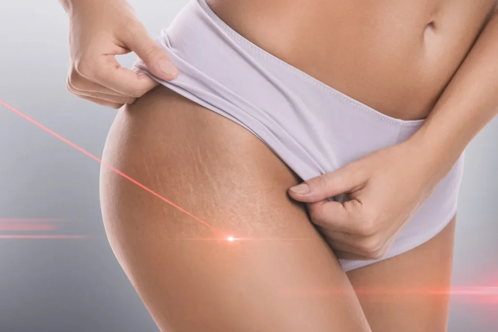 Stretch mark laser in Hoboken, NJ and Weehawken, NJ | 1aesthetics