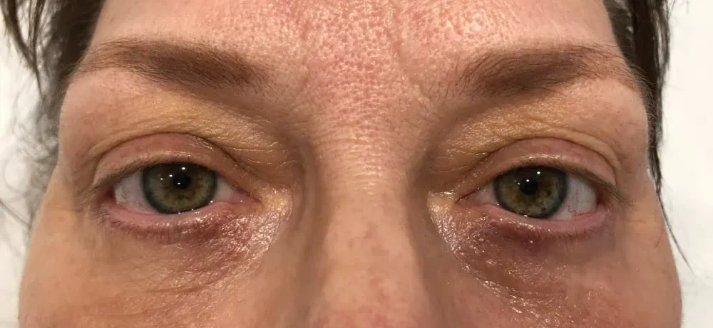 Blepheroplasty After Treatment in Hoboken, NJ and Weehawken, NJ | 1aesthetics