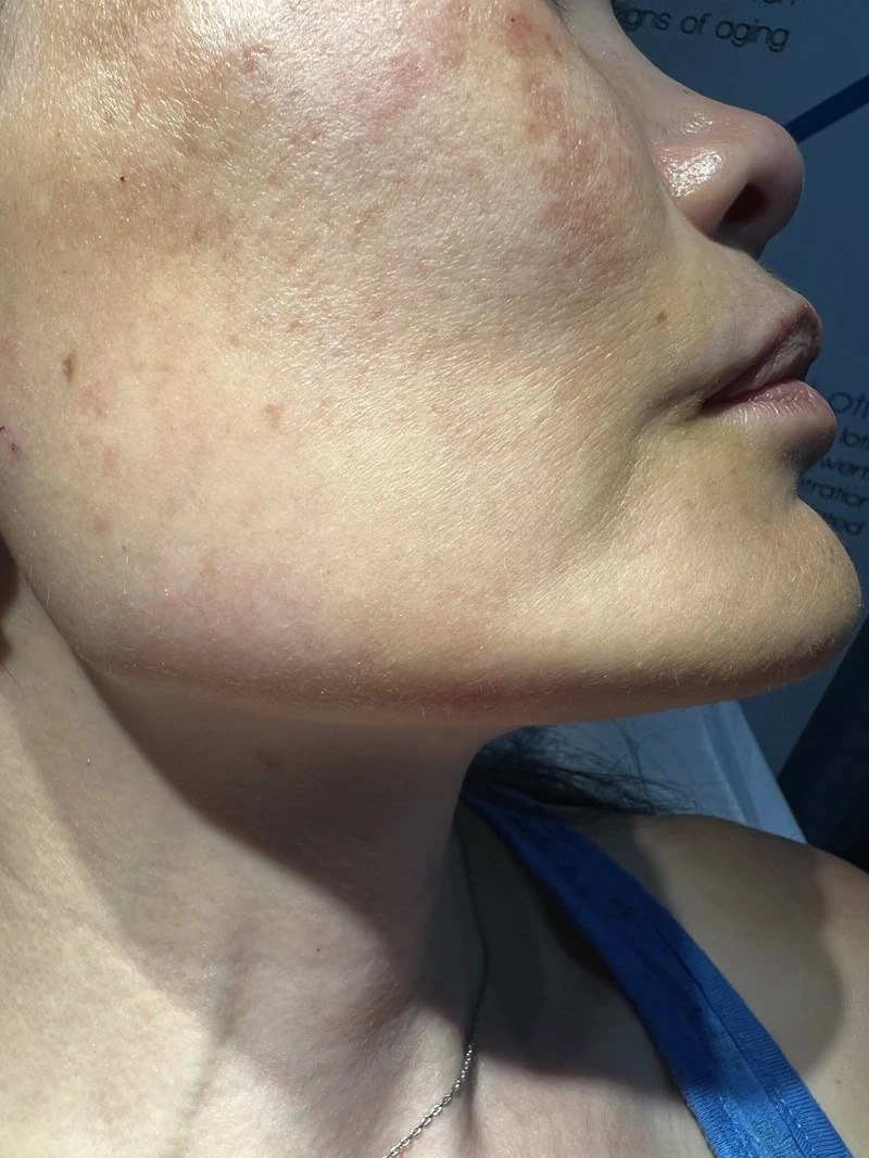 Jawline After Treatment in Hoboken, NJ and Weehawken, NJ | 1aesthetics