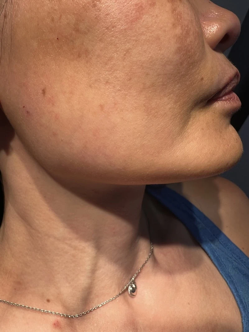 Jawline Before Treatment in Hoboken, NJ and Weehawken, NJ | 1aesthetics