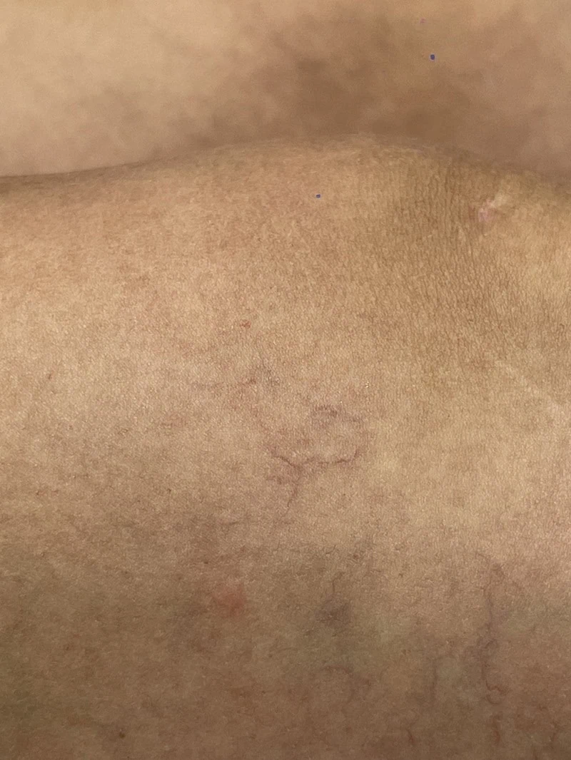 Laser removal before treatment in Hoboken, NJ and Weehawken, NJ | 1aesthetics