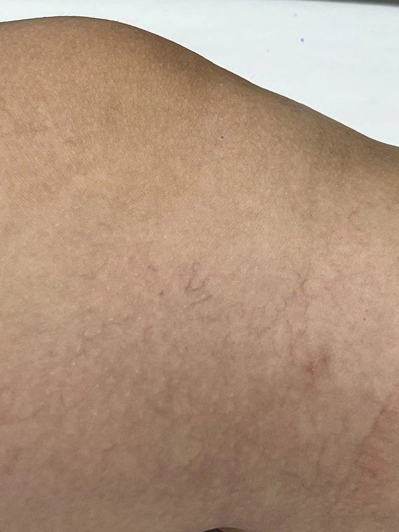 Laser vein removal before in Hoboken, NJ and Weehawken, NJ | 1aesthetics