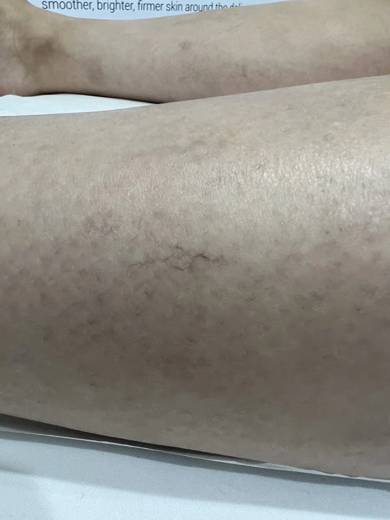 Laser vein Removal Before in Hoboken, NJ and Weehawken, NJ | 1aesthetics