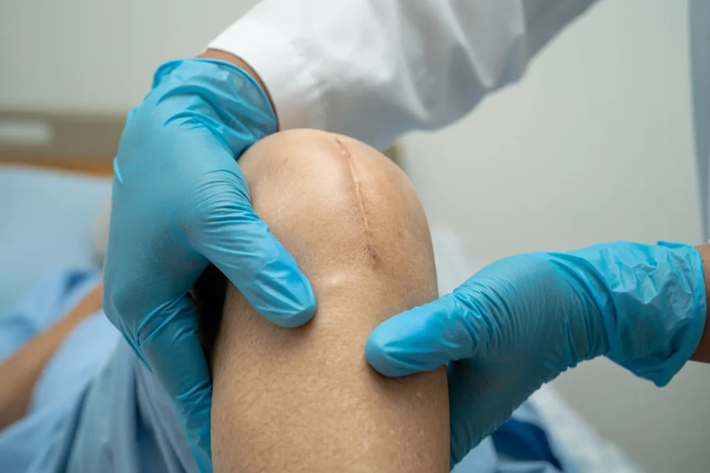 Surgical Scar Removal Treatment in Hoboken, NJ and Weehawken, NJ | 1aesthetics