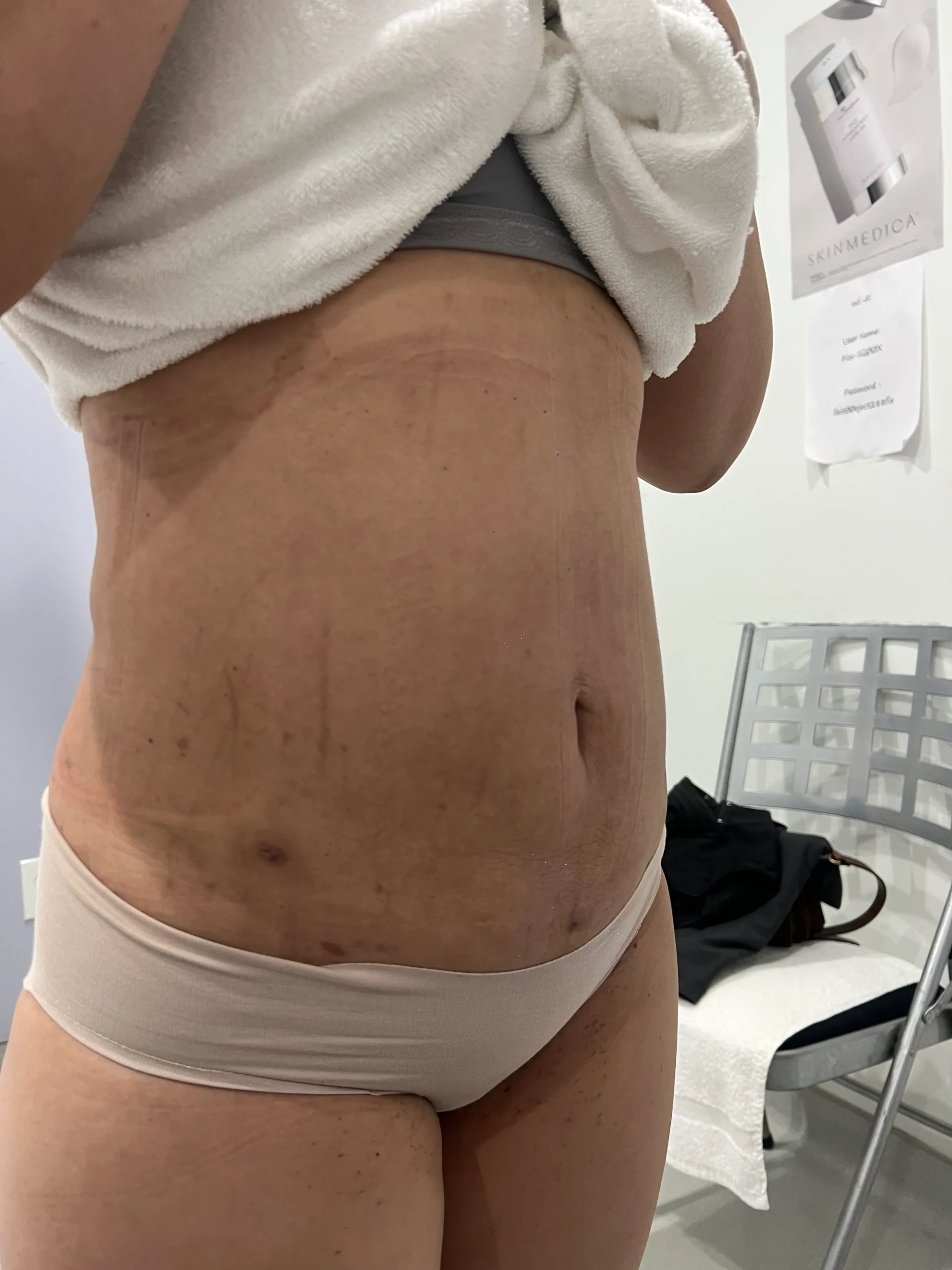 a person with scar on their stomach | 1aesthetics in Hoboken, NJ and Weehawken, NJ