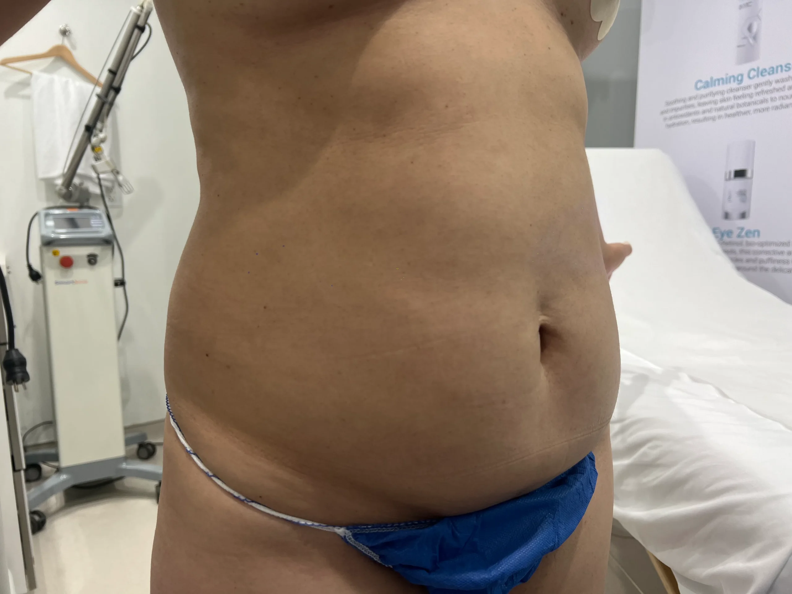 a person's stomach with blue underwear | 1aesthetics in Hoboken, NJ and Weehawken, NJ