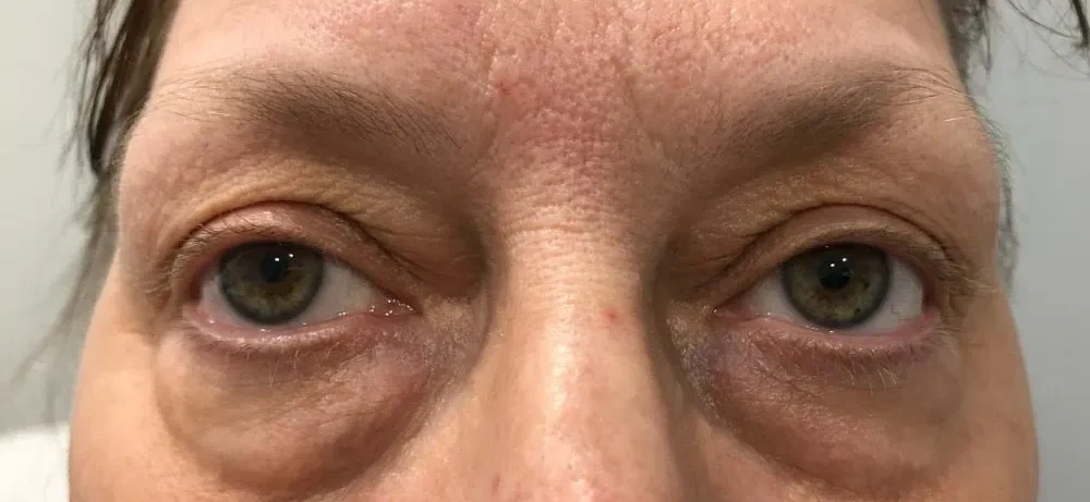 Blepheroplasty Before Treatment in Hoboken, NJ and Weehawken, NJ | 1aesthetics