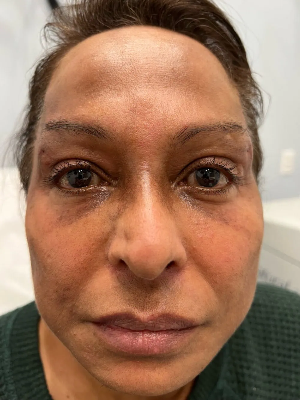 Brow Thread After Treatment in Hoboken, NJ and Weehawken, NJ | 1aesthetics