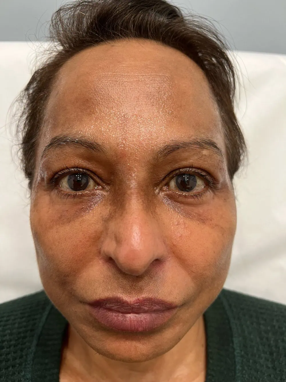 Brow Thread Before Treatment in Hoboken, NJ and Weehawken, NJ | 1aesthetics