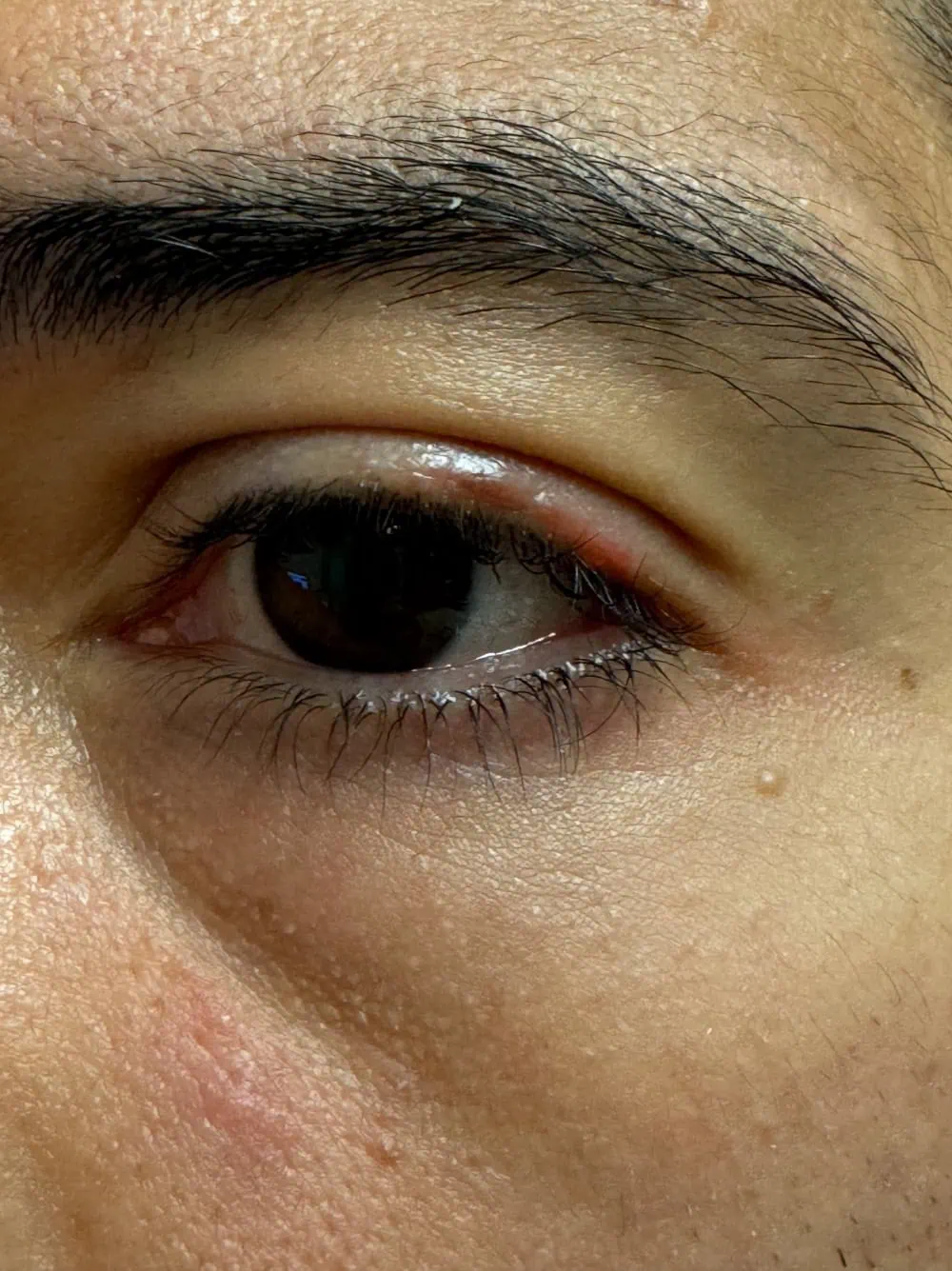 Eyelid Surgery After Treatment in Hoboken, NJ and Weehawken, NJ | 1aesthetics