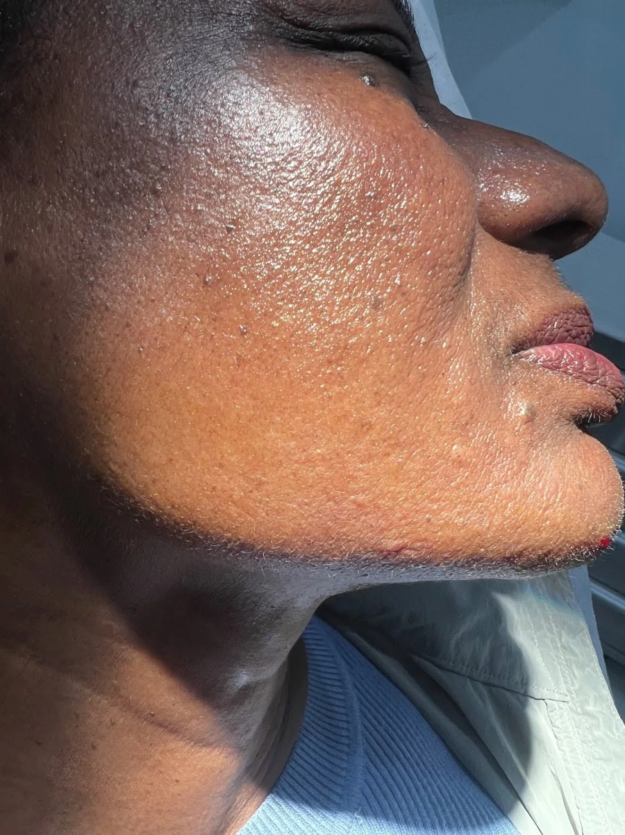 Jawline Filler After Treatment in Hoboken, NJ and Weehawken, NJ | 1aesthetics