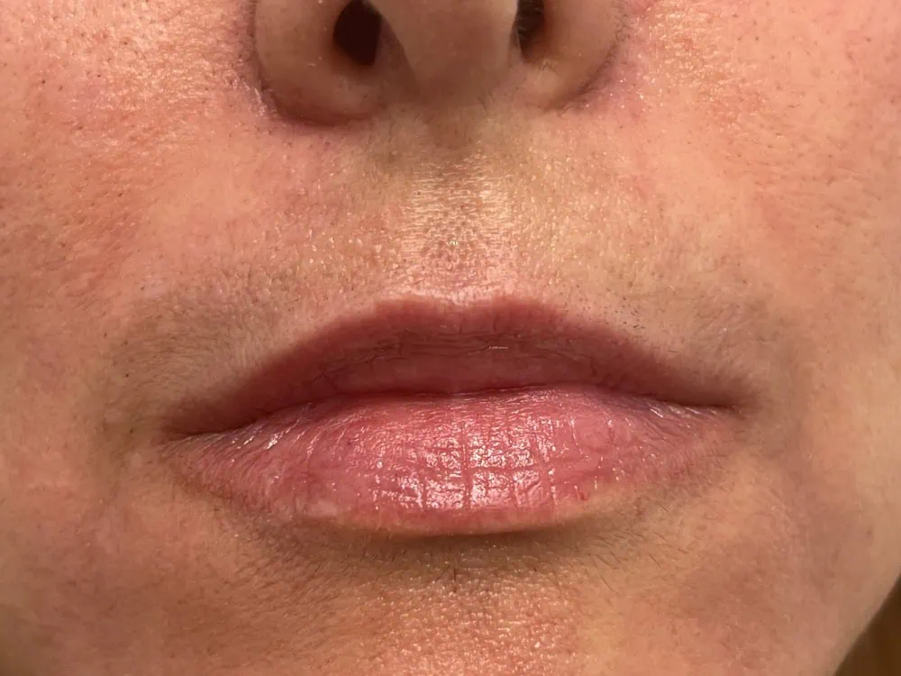 Lips FIller After Treatment in Hoboken, NJ and Weehawken, NJ | 1aesthetics