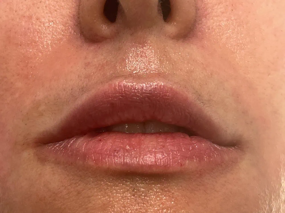 Lips FIller Before Treatment in Hoboken, NJ and Weehawken, NJ | 1aesthetics