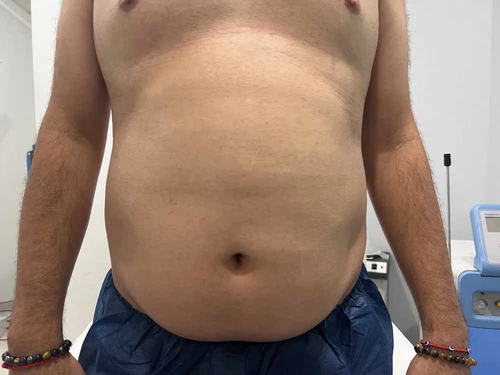 Liposuction Before Treatment in Hoboken, NJ and Weehawken, NJ | 1aesthetics