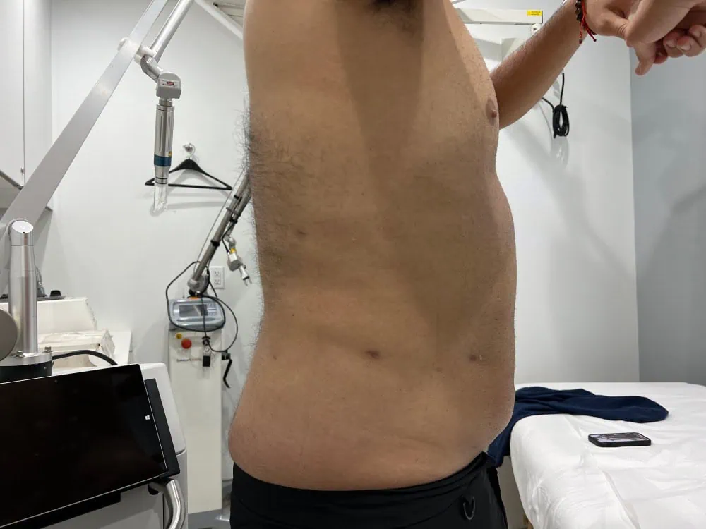 Liposuction After Treatment in Hoboken, NJ and Weehawken, NJ | 1aesthetics