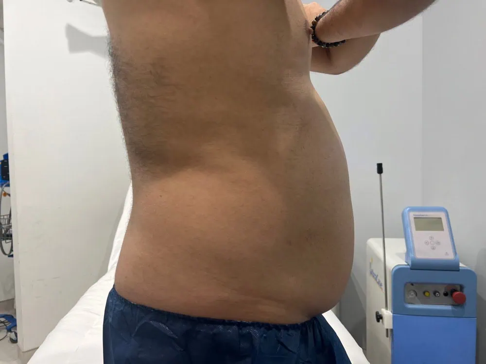 Liposuction Before Treatment in Hoboken, NJ and Weehawken, NJ | 1aesthetics