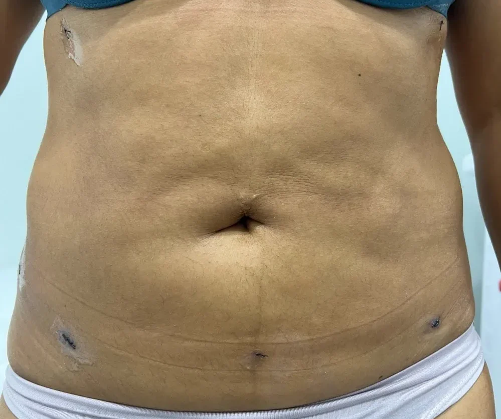 Liposuction After Treatment in Hoboken, NJ and Weehawken, NJ | 1aesthetics