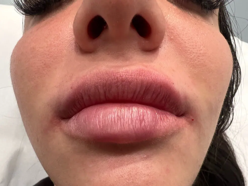 Lips FIller After Treatment in Hoboken, NJ and Weehawken, NJ | 1aesthetics