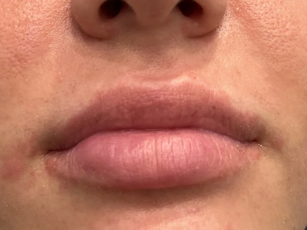 Lips FIller Before Treatment in Hoboken, NJ and Weehawken, NJ | 1aesthetics