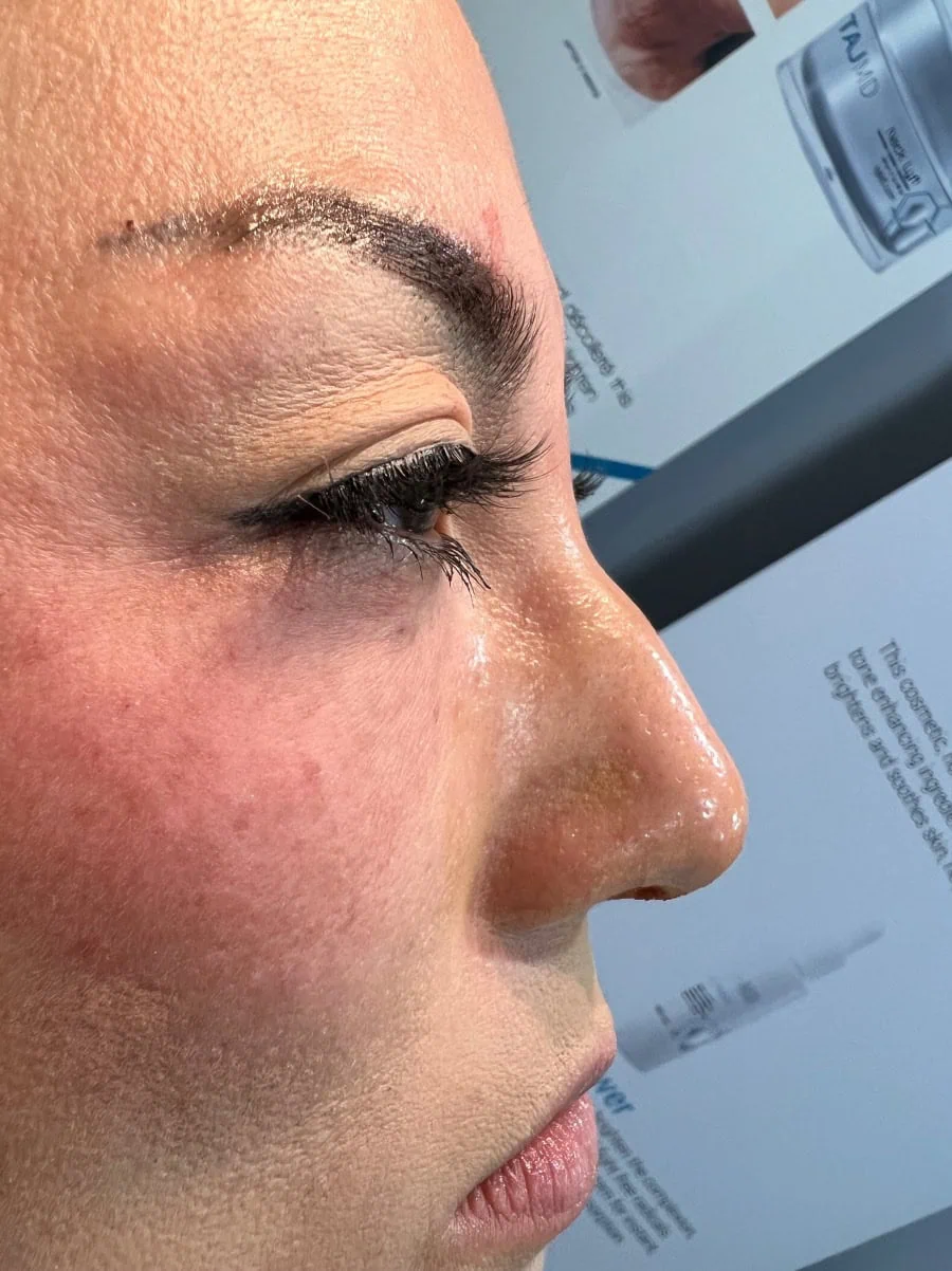 Liquid Nose job Before Treatment in Hoboken, NJ and Weehawken, NJ | 1aesthetics