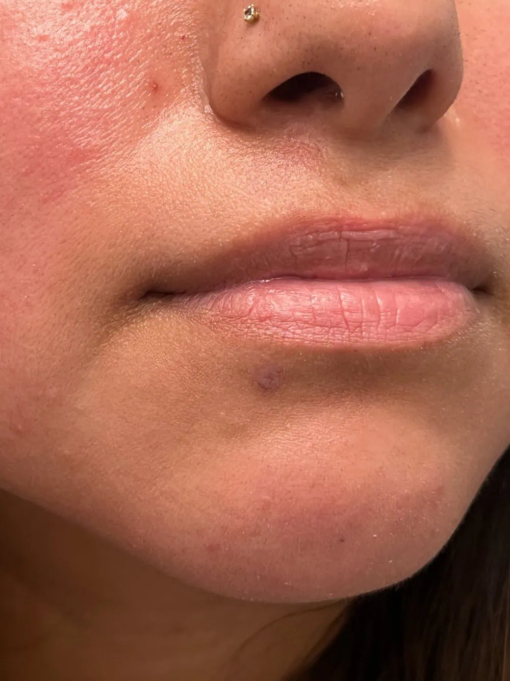 Mole Removal After Treatment in Hoboken, NJ and Weehawken, NJ | 1aesthetics