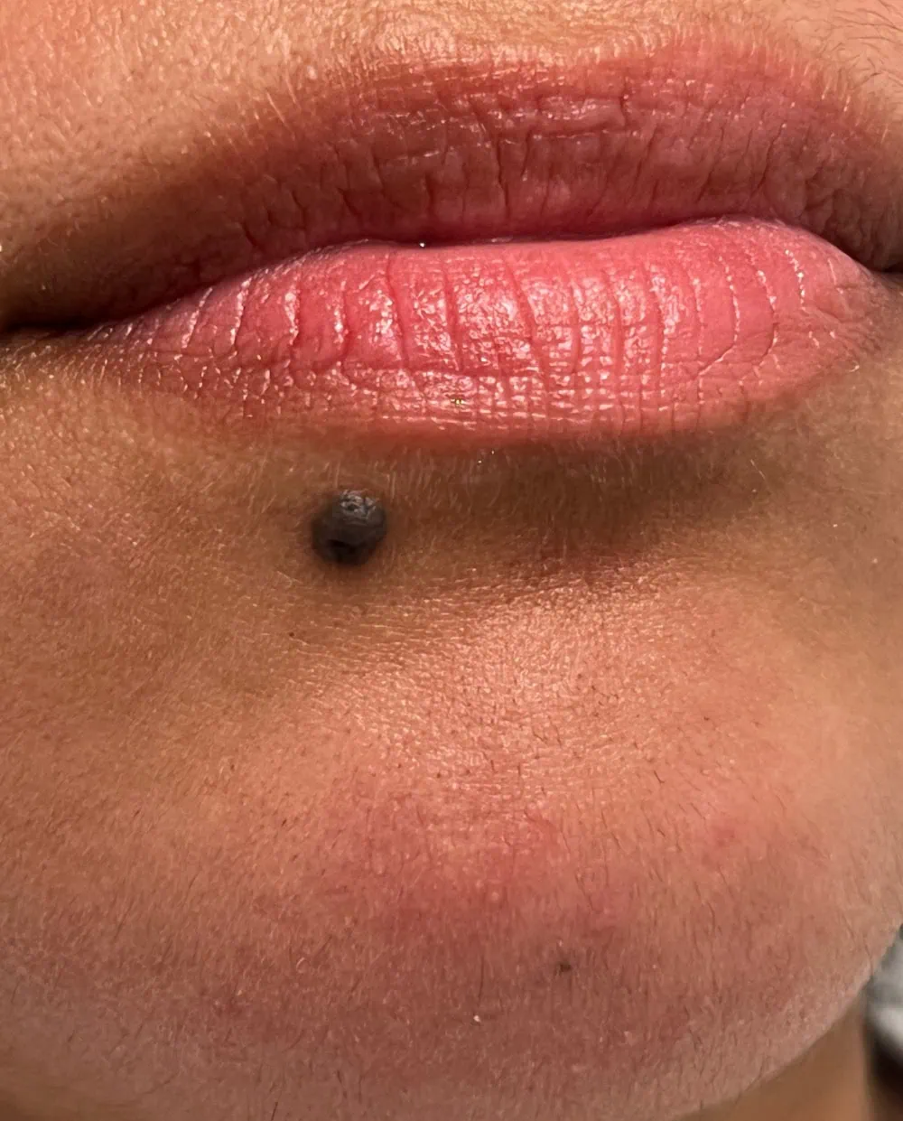 Mole Removal Before Treatment in Hoboken, NJ and Weehawken, NJ | 1aesthetics