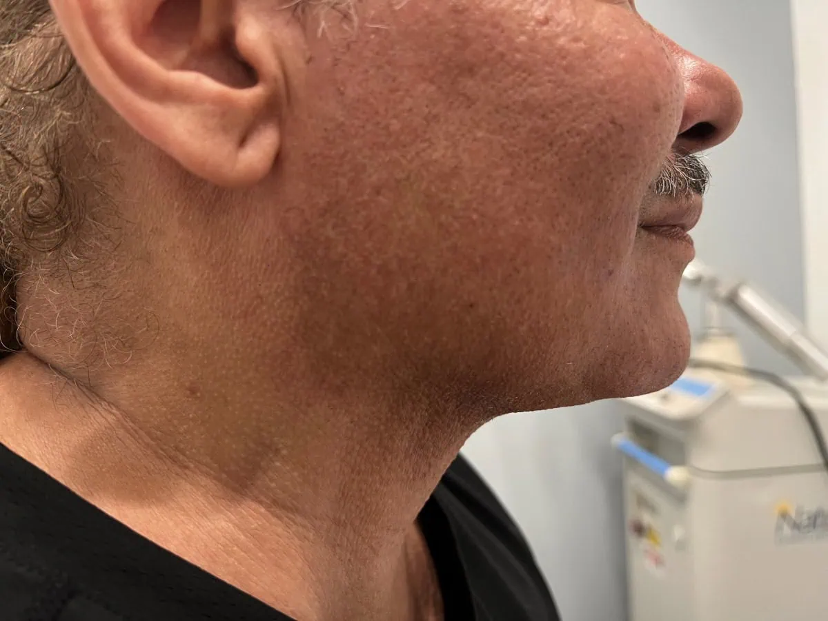 Neck Lipo After Treatment in Hoboken, NJ and Weehawken, NJ | 1aesthetics