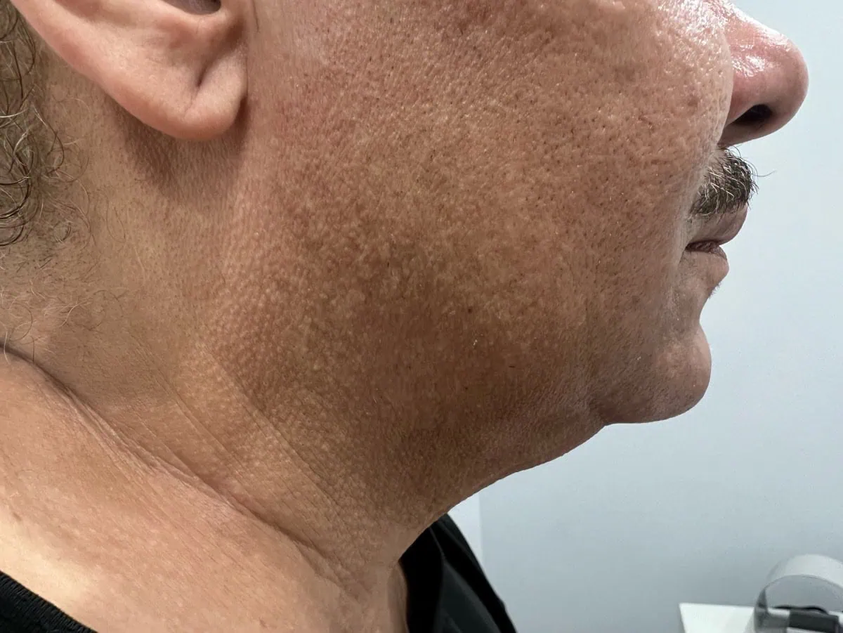 Neck Lipo Before Treatment in Hoboken, NJ and Weehawken, NJ | 1aesthetics