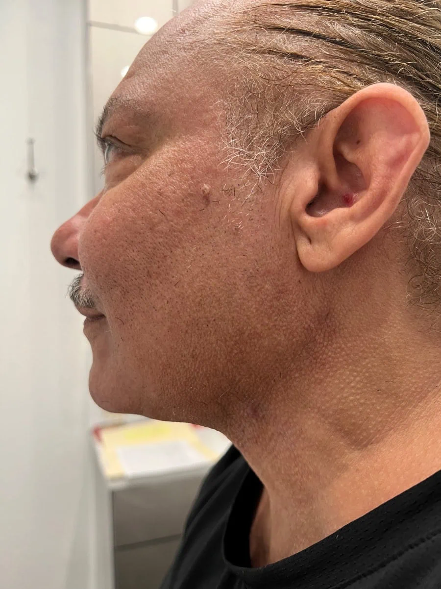 Neck Lipo After Treatment in Hoboken, NJ and Weehawken, NJ | 1aesthetics