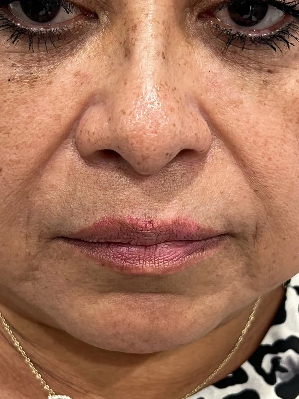 Smile Lines Filler Before Treatment in Hoboken, NJ and Weehawken, NJ | 1aesthetics