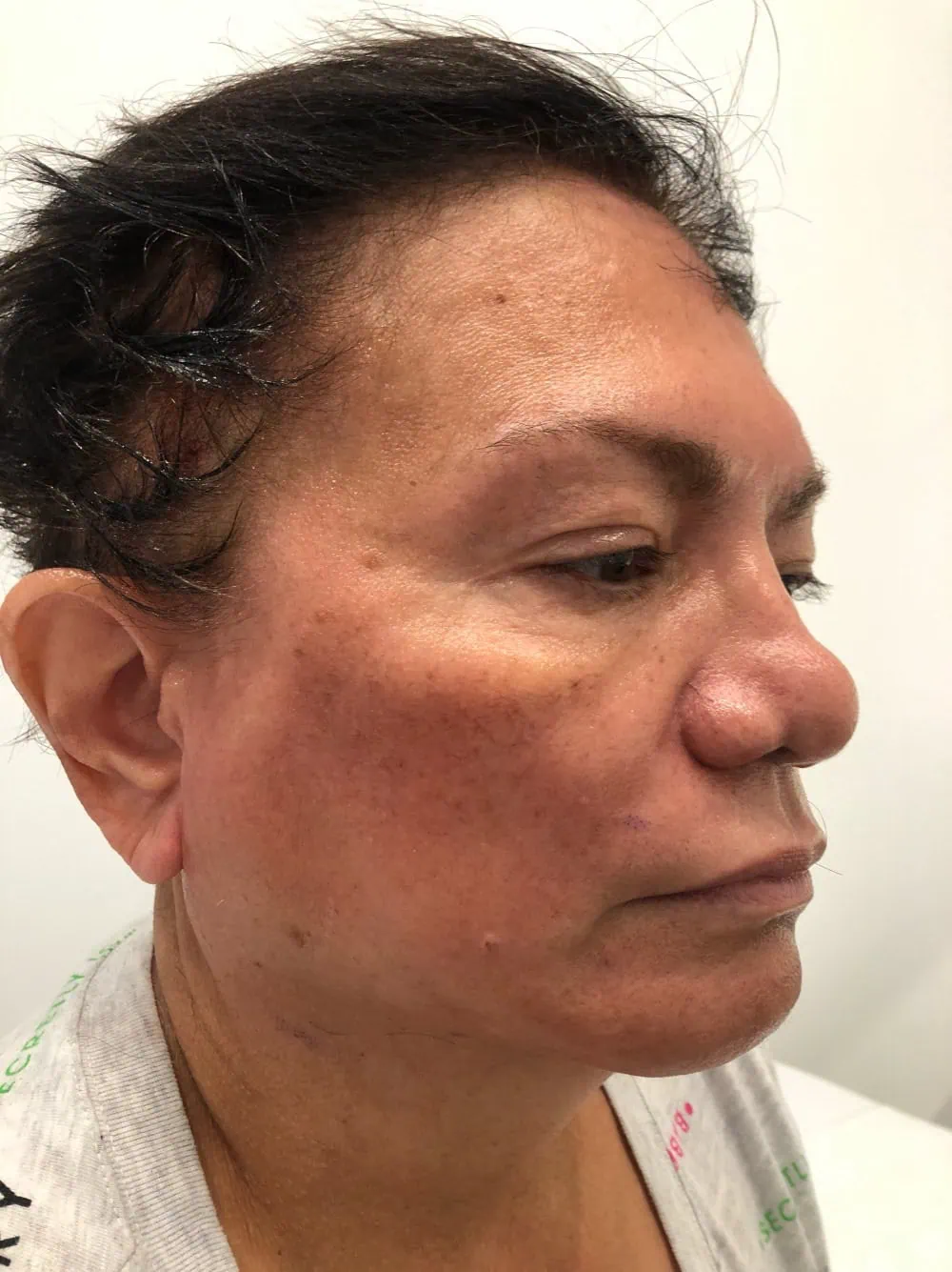 Thread Lift After Treatment in Hoboken, NJ and Weehawken, NJ | 1aesthetics