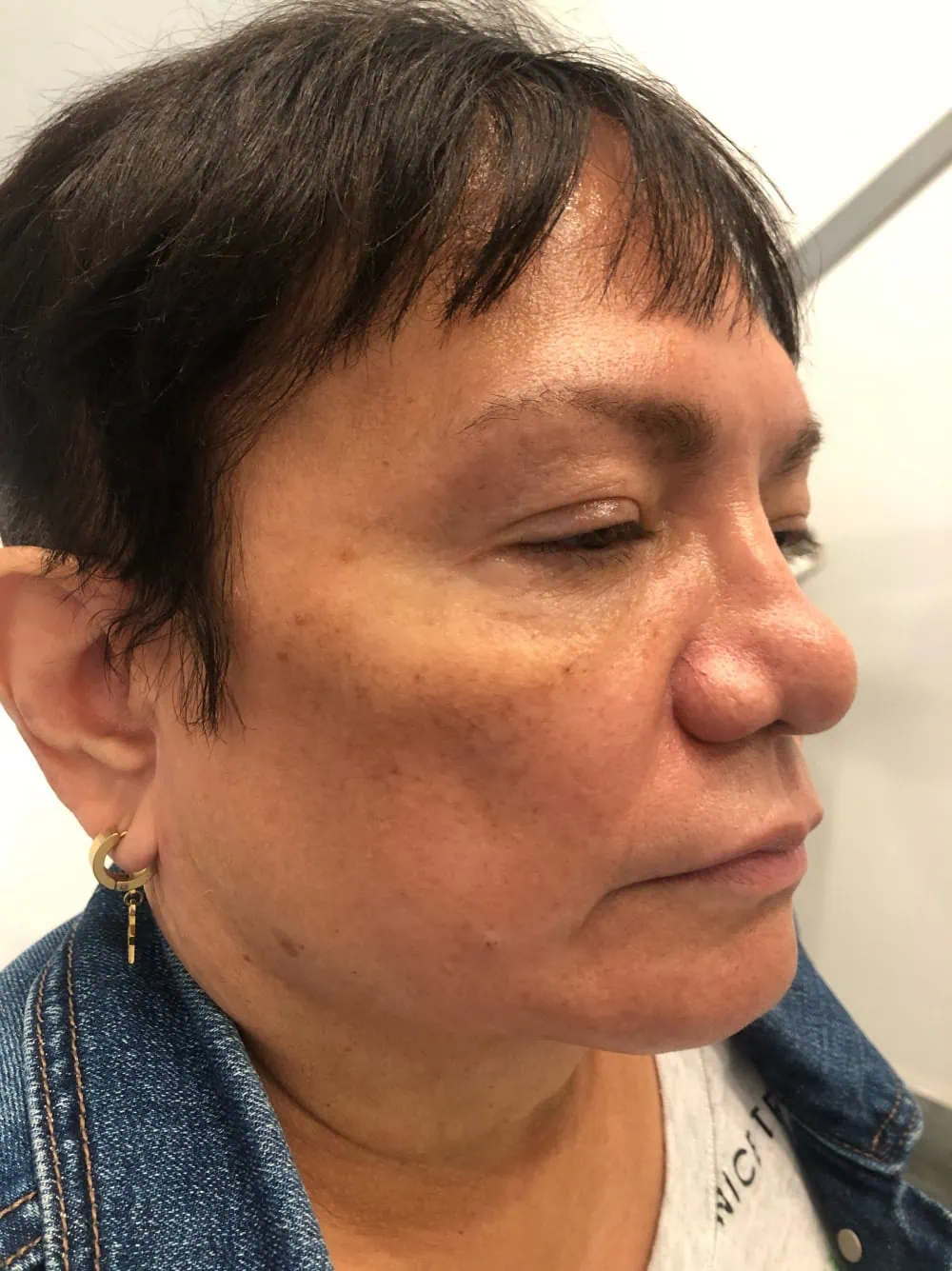 Thread Lift Before Treatment in Hoboken, NJ and Weehawken, NJ | 1aesthetics