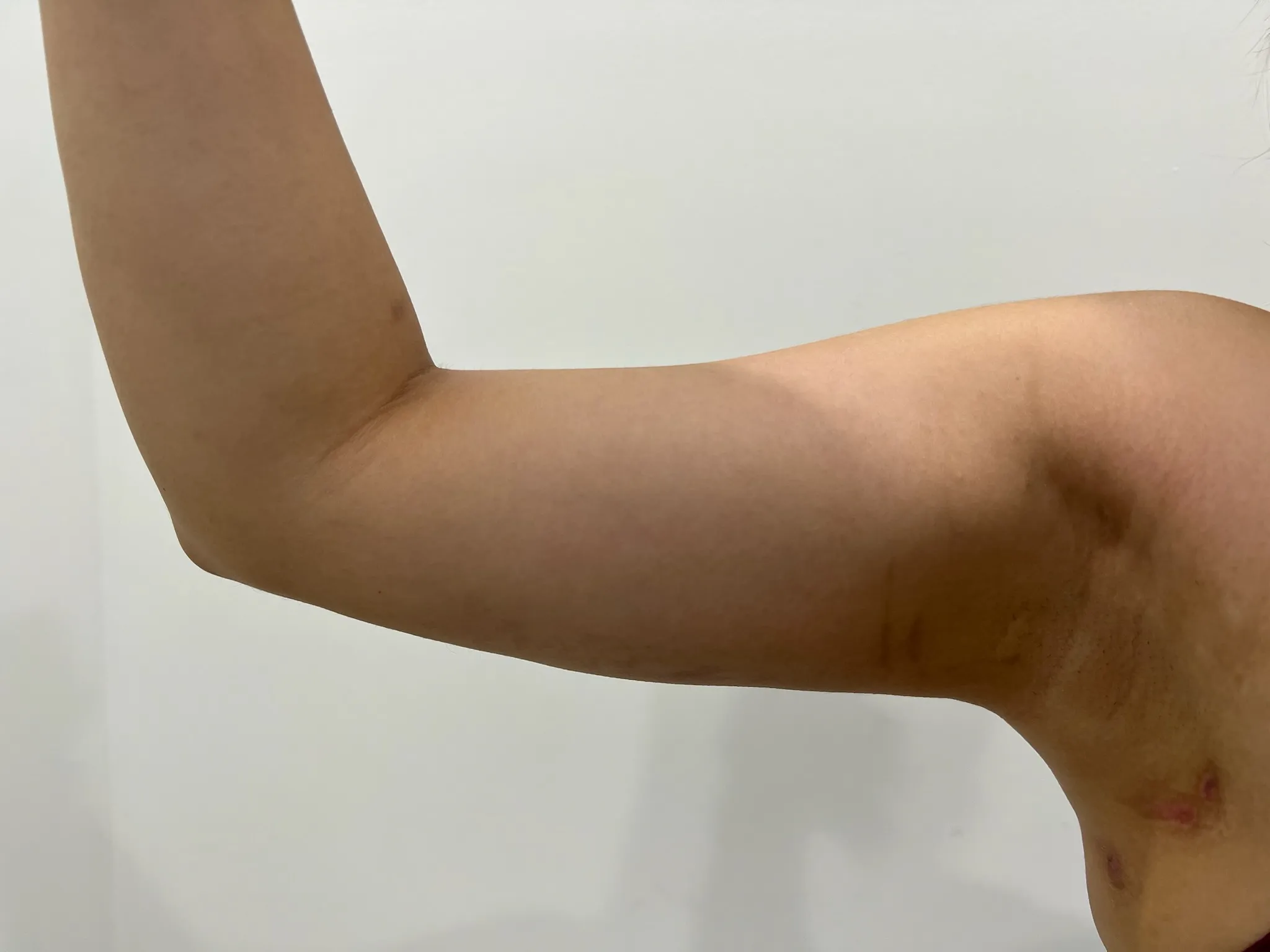 a person's arm with a white background | 1aesthetics in Hoboken, NJ and Weehawken, NJ