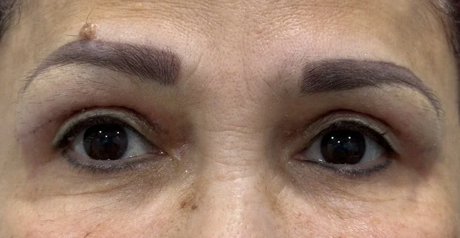 Blepheroplasty After Treatment in Hoboken, NJ and Weehawken, NJ | 1aesthetics