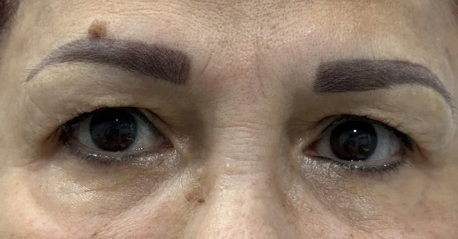 Blepheroplasty Before Treatment in Hoboken, NJ and Weehawken, NJ | 1aesthetics