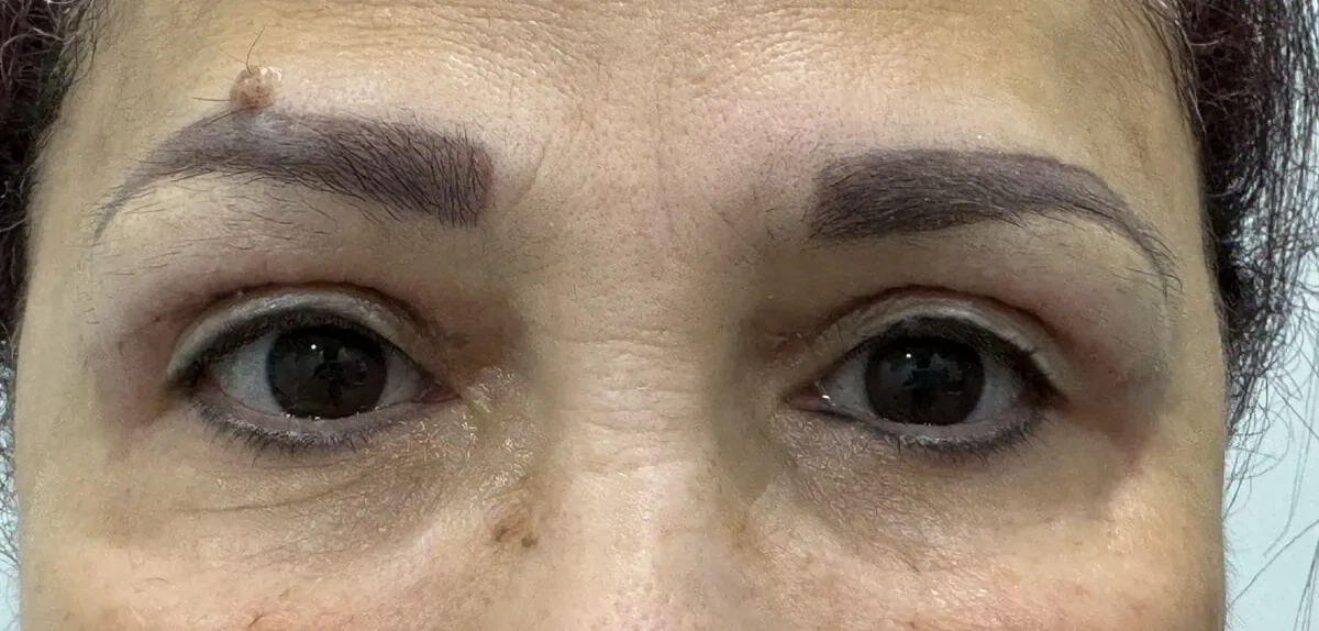 Blepheroplasty After Treatment in Hoboken, NJ and Weehawken, NJ | 1aesthetics