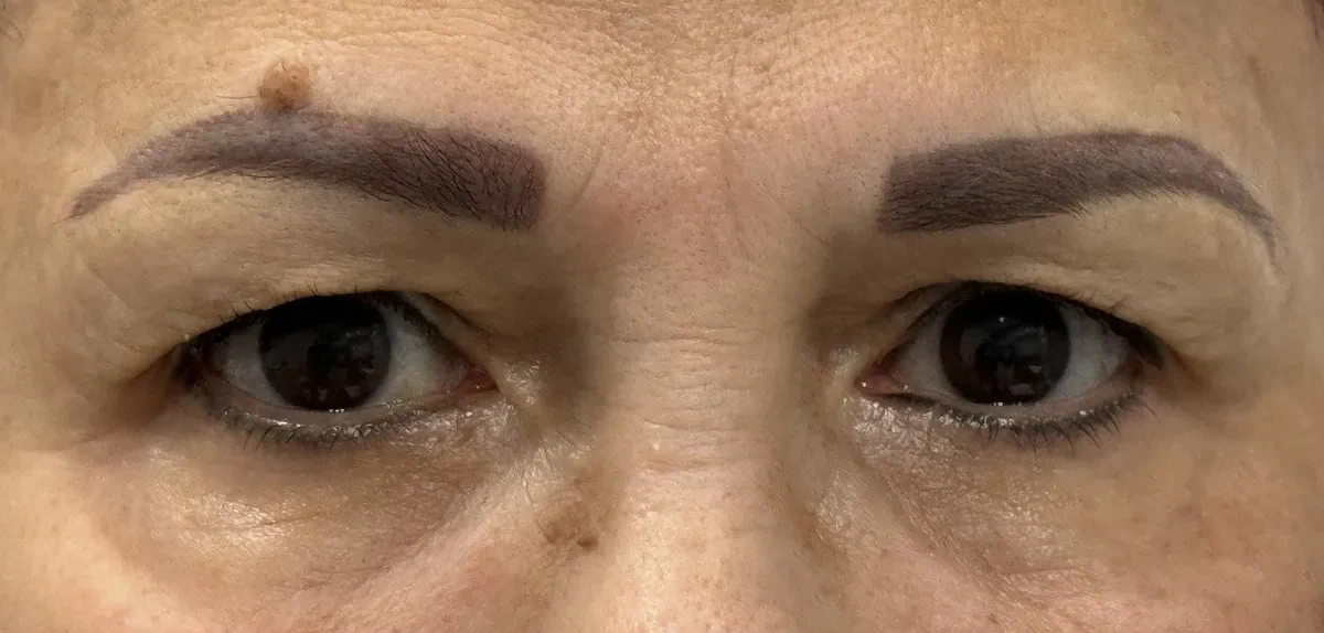 Blepheroplasty Before Treatment in Hoboken, NJ and Weehawken, NJ | 1aesthetics