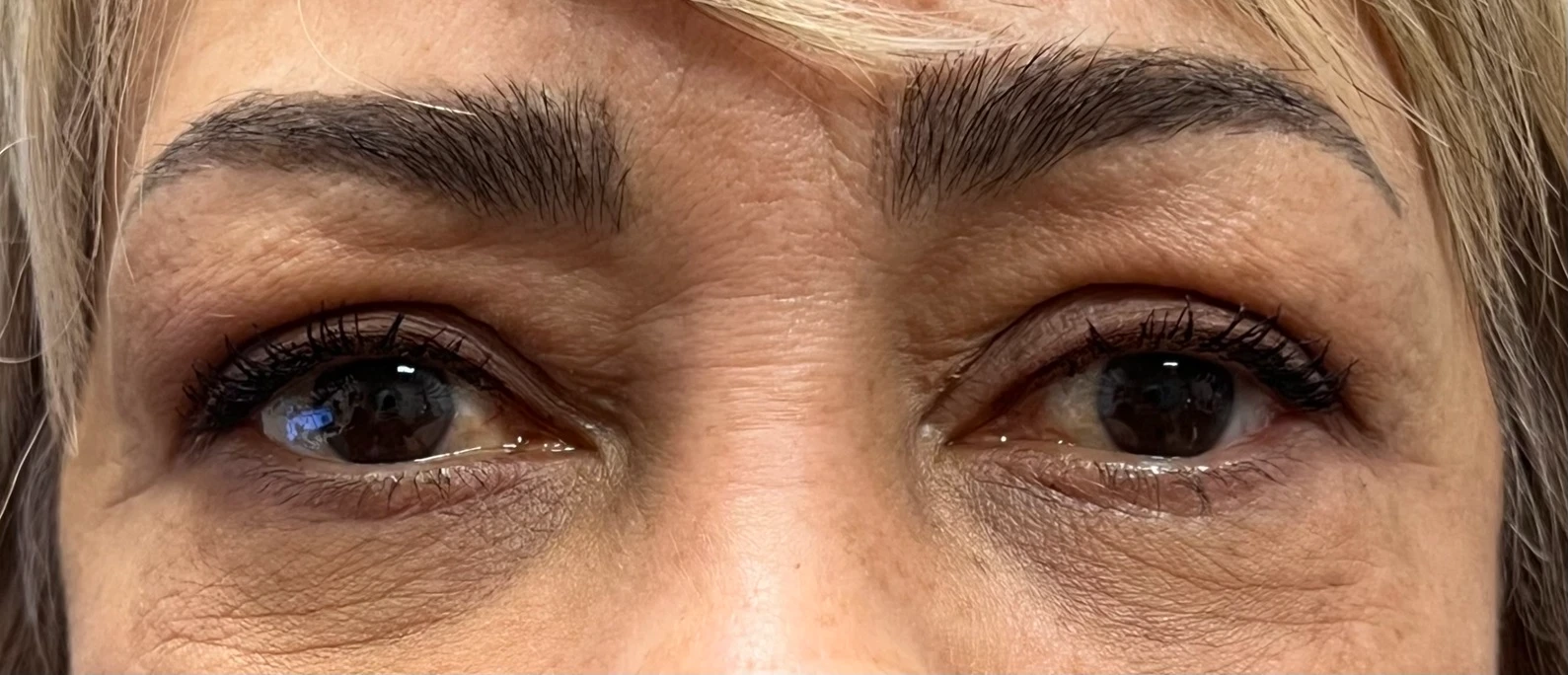 Blepharoplasty After in Hoboken, NJ and Weehawken, NJ | 1aesthetics