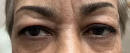 Blepharoplasty Before in Hoboken, NJ and Weehawken, NJ | 1aesthetics