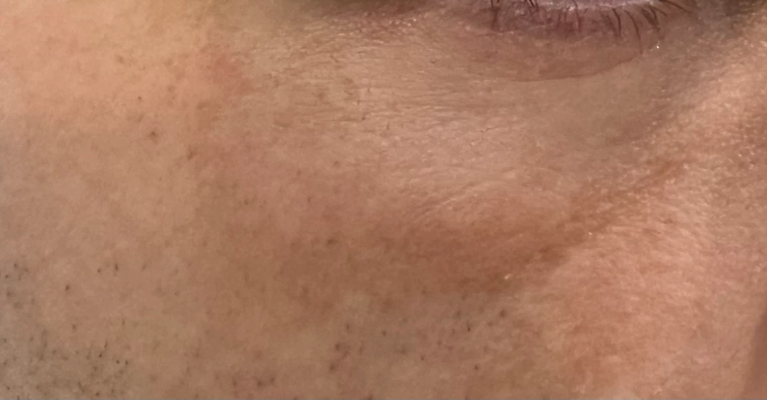 Dot Laser Forehead Before & After in Hoboken, NJ and Weehawken, NJ