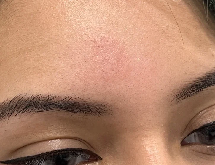 Dot Laser Forehead Before After in Hoboken, NJ and Weehawken, NJ