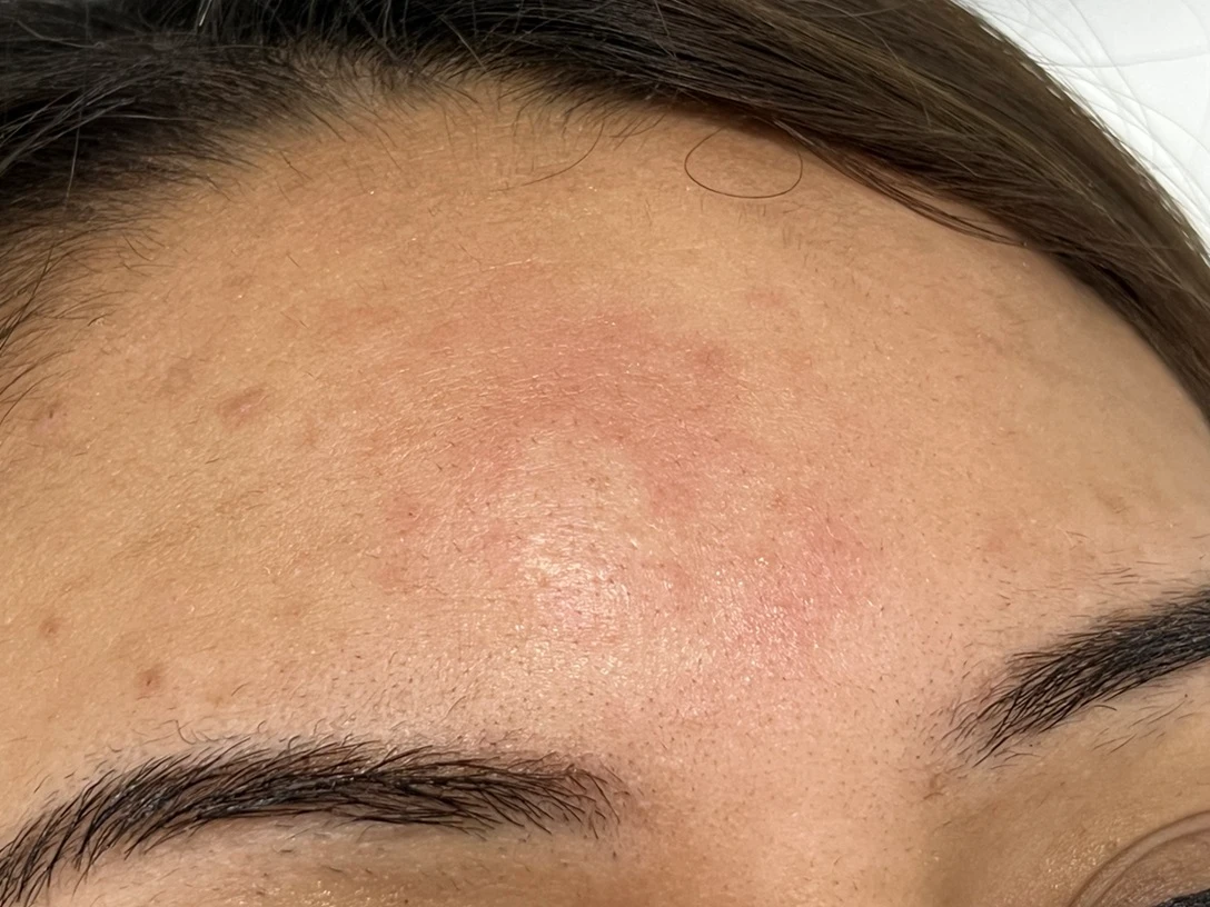 Dot Laser Forehead Before After in Hoboken, NJ and Weehawken, NJ